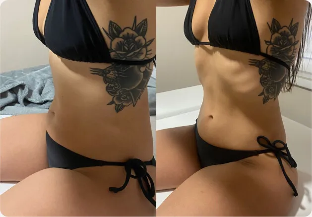 Antes e depois do abdômen, de perfil