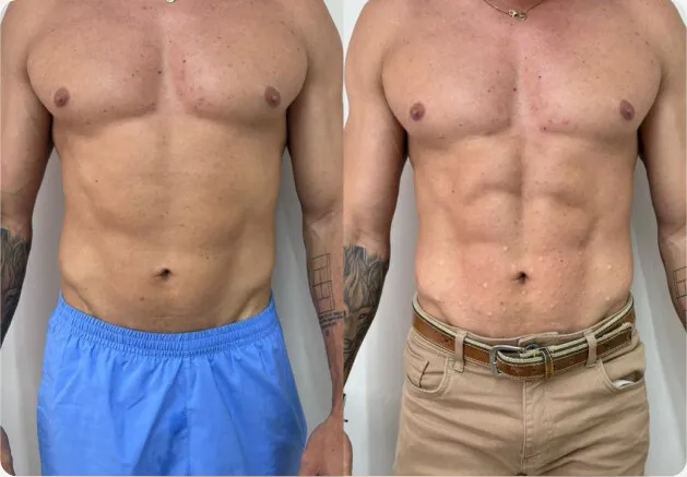Antes e depois de abdômen masculino