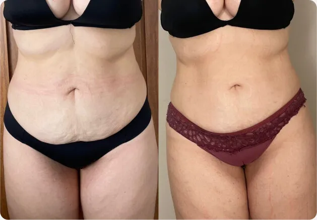 Antes e depois do abdômen, de frente