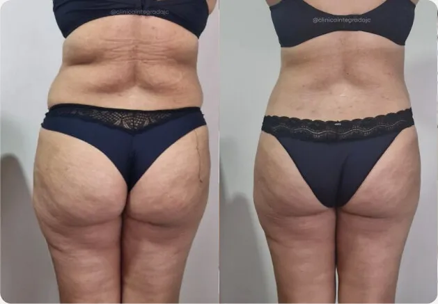 Antes e depois de quadril e coxas, de costas