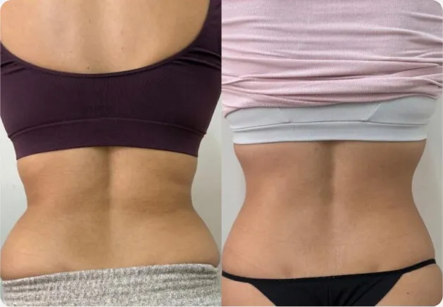 Antes e depois das costas e flancos