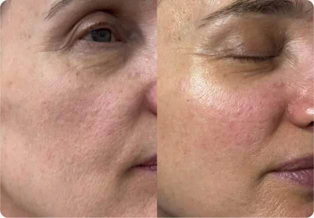 Antes e depois das linhas finas ao redor dos olhos