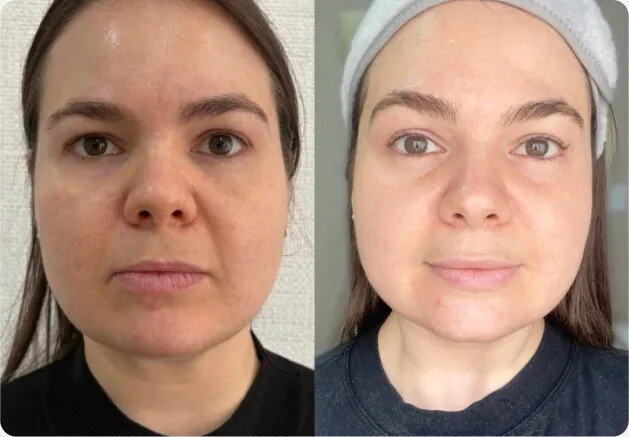 Antes e depois do rosto inteiro, de frente